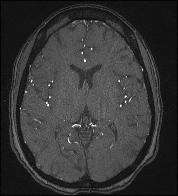 Cerebral fat embolism (Radiopaedia 35022-36525 Axial TOF 110).jpg