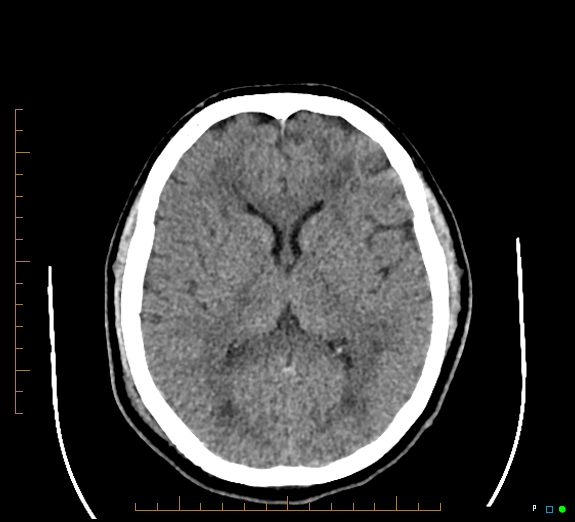 File:Cerebral fat embolism (Radiopaedia 85521-101220 Axial non-contrast 34).jpg