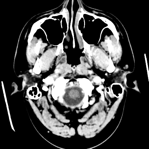 Cerebral hemorrhage secondary to arteriovenous malformation (Radiopaedia 33497-34561 B 6).png