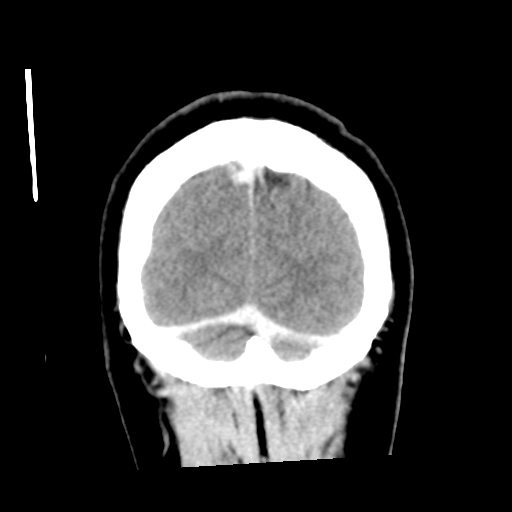 Cerebral hemorrhage secondary to arteriovenous malformation (Radiopaedia 33497-34561 C 60).png