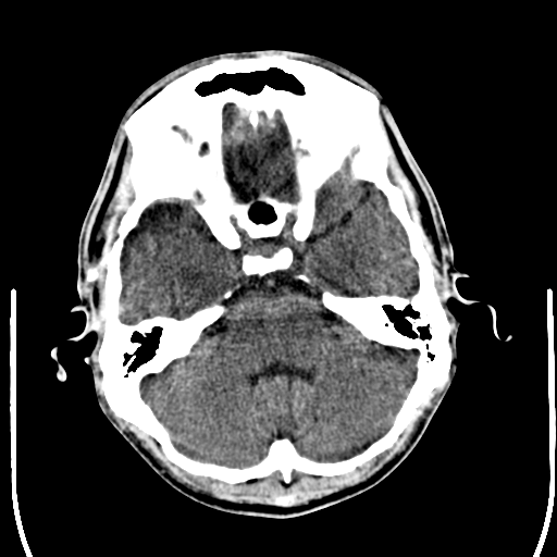File:Cerebral hemorrhagic contusions- temporal evolution (Radiopaedia 40224-42756 Axial non-contrast 6).png