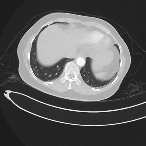 Cerebral metastases (Radiopaedia 33041-34055 Axial lung window 44).png