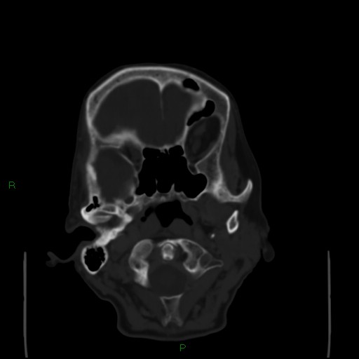 Cerebral metastases - breast primary (Radiopaedia 77653-89857 Axial bone window 18).jpg