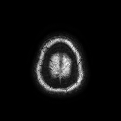 Cerebral metastases - melanoma (Radiopaedia 80972-94522 Axial SWI 96).jpg