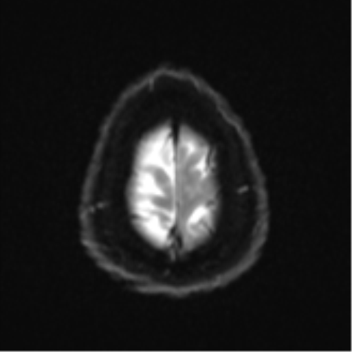Cerebral metastases mimicking multifocal glioblastoma (Radiopaedia 50843-56353 Axial DWI 25).png