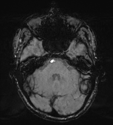 Cerebral metastasis - melanoma (Radiopaedia 54718-60954 Axial SWI 15).png