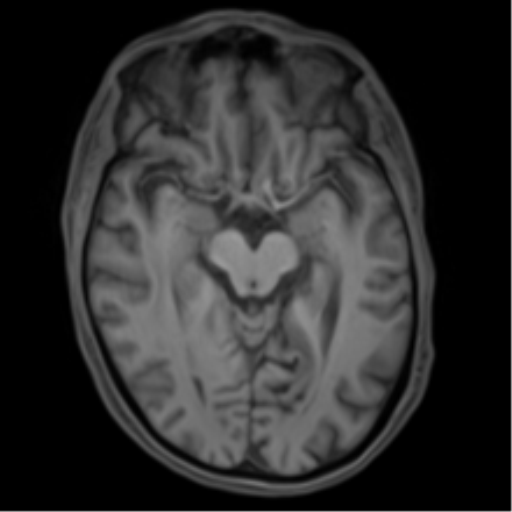 Cerebral metastasis - melanoma (Radiopaedia 54718-60954 Axial T1 23).png