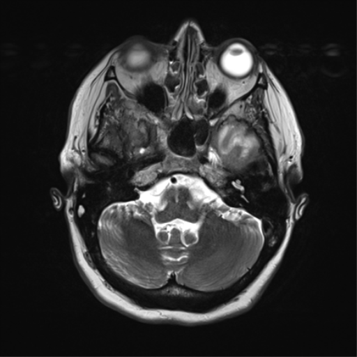 File:Cerebral metastasis mimicking glioblastoma (Radiopaedia 69155-78937 Axial T2 10).png