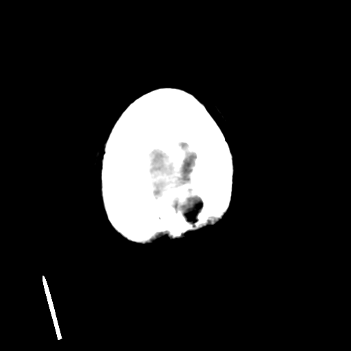Cerebral metastasis to basal ganglia (Radiopaedia 81568-95412 Axial non-contrast 56).png