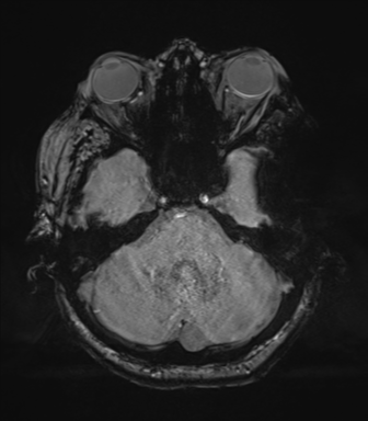 Cerebral metastasis to basal ganglia (Radiopaedia 81568-95413 Axial SWI magnitude 20).png