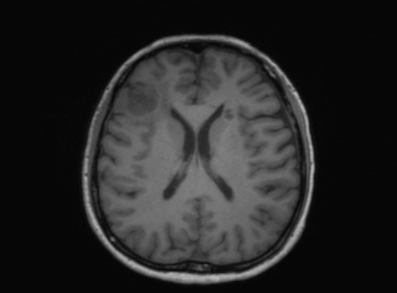 Cerebral ring enhancing lesions - cerebral metastases (Radiopaedia 44922-48817 Axial T1 202).jpg