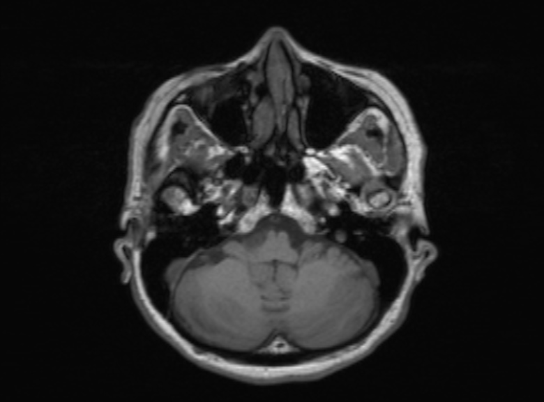 Cerebral ring enhancing lesions - cerebral metastases (Radiopaedia 44922-48817 Axial T1 312).jpg