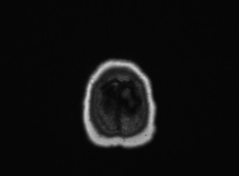 Cerebral ring enhancing lesions - cerebral metastases (Radiopaedia 44922-48817 Axial T1 93).jpg