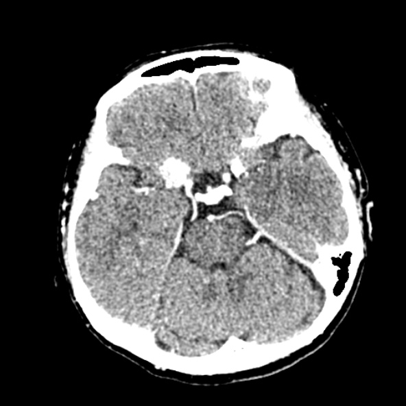 Cerebral ring enhancing lesions - cerebral metastases (Radiopaedia 44922-48818 B 101).jpg