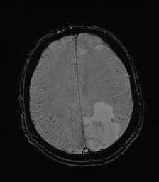 File:Cerebral toxoplasmosis (Radiopaedia 43956-47461 Axial SWI 29).jpg