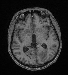 Cerebral toxoplasmosis (Radiopaedia 43956-47461 Axial T1 37).jpg
