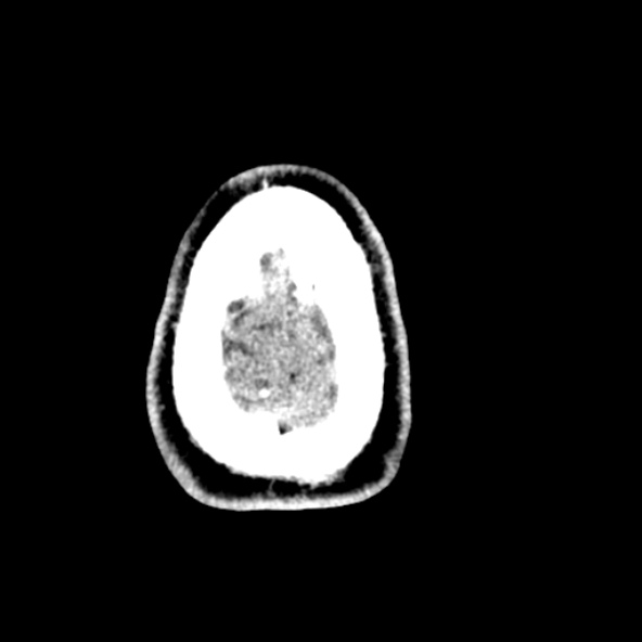 Cerebral toxoplasmosis (Radiopaedia 53993-60131 Axial non-contrast 73).jpg