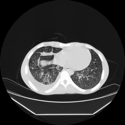 Cerebral tuberculoma (Radiopaedia 80829-94318 Axial lung window 129).jpg