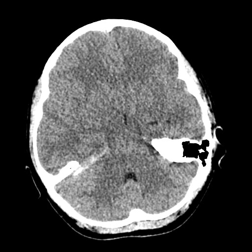 Cerebral tuberculosis with dural sinus invasion (Radiopaedia 60353-68018 Axial non-contrast 18).jpg