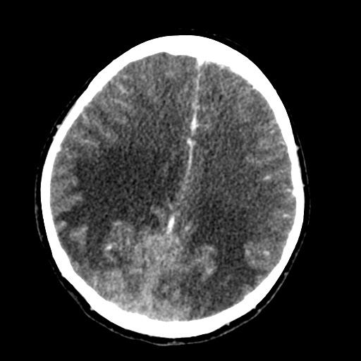 Cerebral tuberculosis with dural sinus invasion (Radiopaedia 60353-68019 Axial C+ delayed 43).jpg
