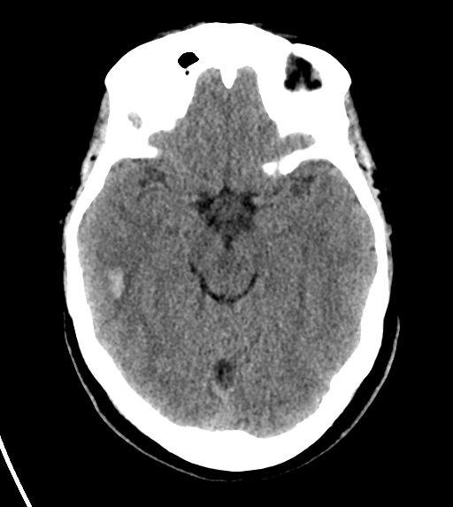 File:Cerebral venous infarct related to dural venous sinus thromboses (Radiopaedia 35292-36804 Axial non-contrast 12).png