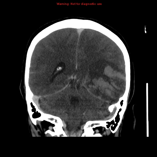 Cerebral venous infarction (Radiopaedia 12404-20735 B 55).jpg