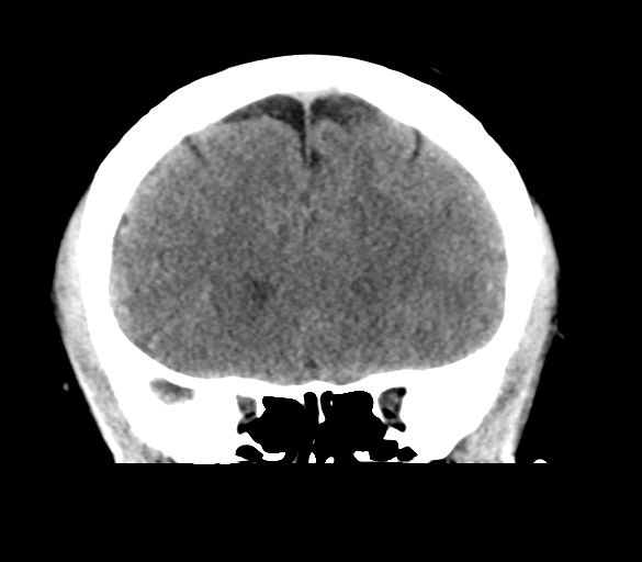 File:Cerebral venous infarction due to transverse sinus thrombosis (Radiopaedia 34688-36116 Coronal non-contrast 13).png
