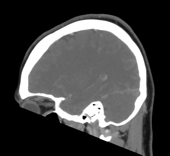 Cerebral venous infarction due to transverse sinus thrombosis (Radiopaedia 34688-36120 Sagittal CT venogram 19).png