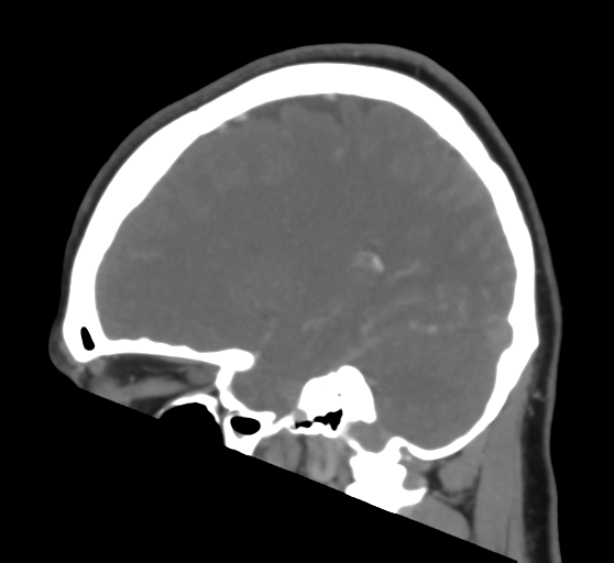 Cerebral venous infarction due to transverse sinus thrombosis (Radiopaedia 34688-36120 Sagittal CT venogram 21).png