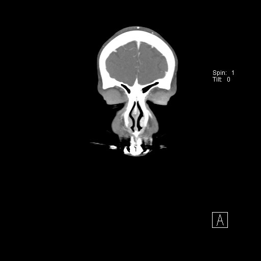 File:Cerebral venous infarction with hemorrhage (Radiopaedia 65343-74396 B 19).jpg