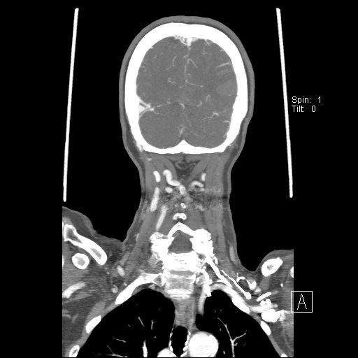 Cerebral venous infarction with hemorrhage (Radiopaedia 65343-74396 B 226).jpg