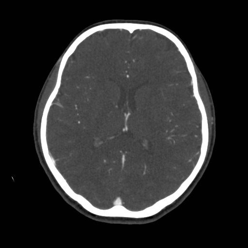 Cerebral venous sinus thrombosis (Radiopaedia 40619-43227 A 128).jpg