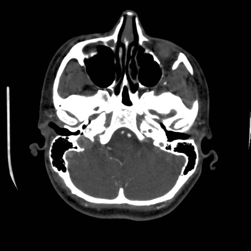 Cerebral venous sinus thrombosis (Radiopaedia 40619-43227 A 44).jpg