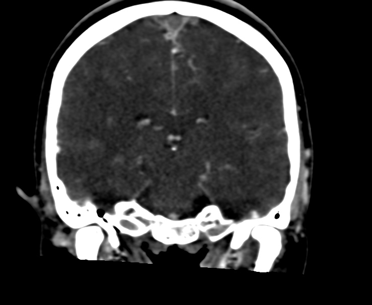 Cerebral venous sinus thrombosis (Radiopaedia 59224-66646 Coronal C+ delayed 43).jpg