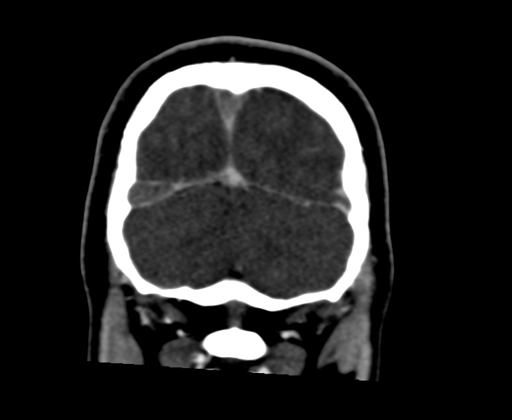 Cerebral venous sinus thrombosis (Radiopaedia 59224-66646 Coronal C+ delayed 68).jpg