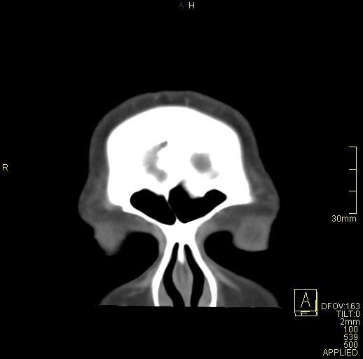 Cerebral venous sinus thrombosis (Radiopaedia 91329-108965 Coronal venogram 8).jpg