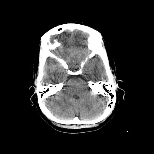 Cerebral venous throbmosis - hemorrhagic venous infarction (Radiopaedia 87318-103613 Axial non-contrast 44).jpg