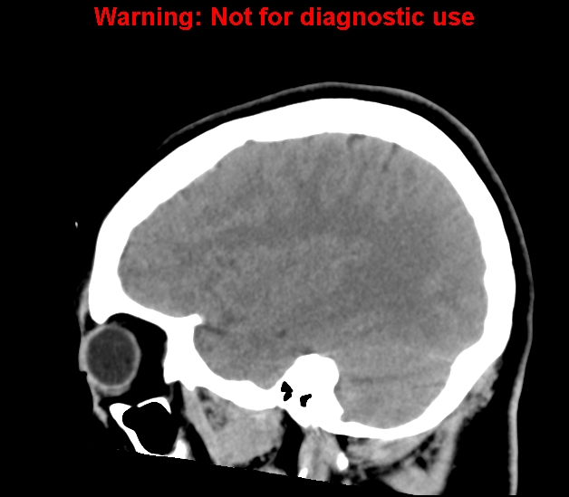 File:Cerebral venous thrombosis (Radiopaedia 37224-38992 B 9).jpg