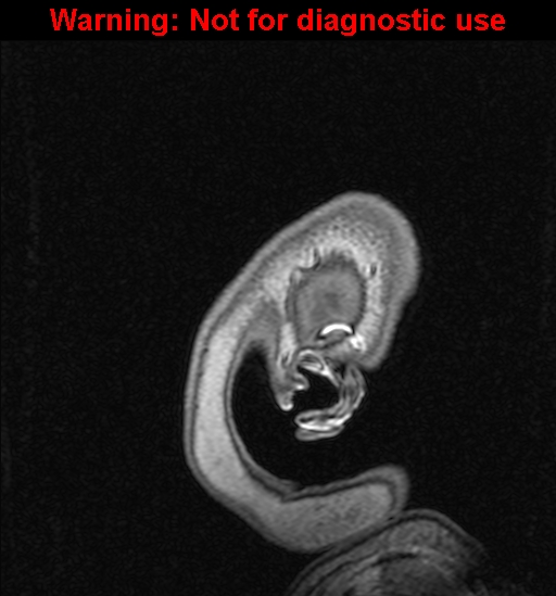 Cerebral venous thrombosis (Radiopaedia 37224-39208 Sagittal T1 C+ 152).jpg