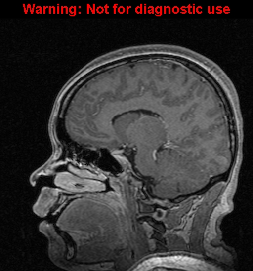 File:Cerebral venous thrombosis (Radiopaedia 37224-39208 Sagittal T1 C+ 67).jpg