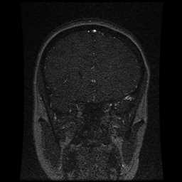 Cerebral venous thrombosis - ulcerative colitis (Radiopaedia 66049-75219 Coronal MRV 82).jpg