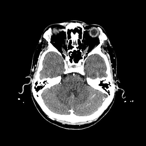 File:Cerebral venous thrombosis with venous hemorrhagic infarct (Radiopaedia 90354-107660 Axial with contrast 50).jpg