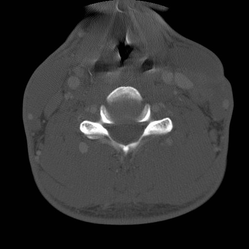 Cervical Pott disease (Radiopaedia 20374-20286 Axial bone window 91).jpg