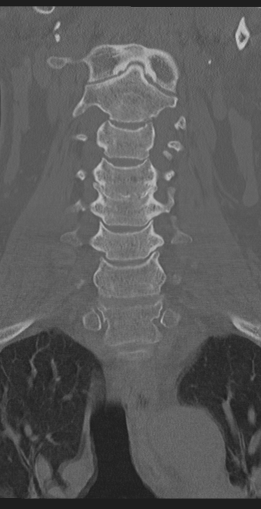 Cervical canal stenosis due to ossification of the posterior longitudinal ligament (Radiopaedia 47260-51823 Coronal bone window 21).png