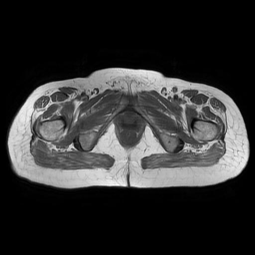 File:Cervical carcinoma (Radiopaedia 67644-77047 Axial T1 19).jpg