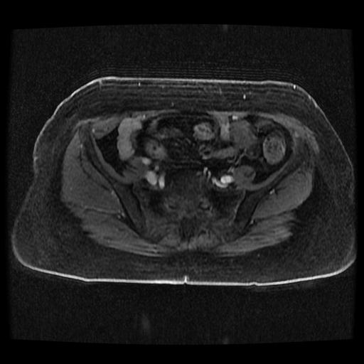 Cervical carcinoma (Radiopaedia 70924-81132 Axial T1 C+ fat sat 247).jpg