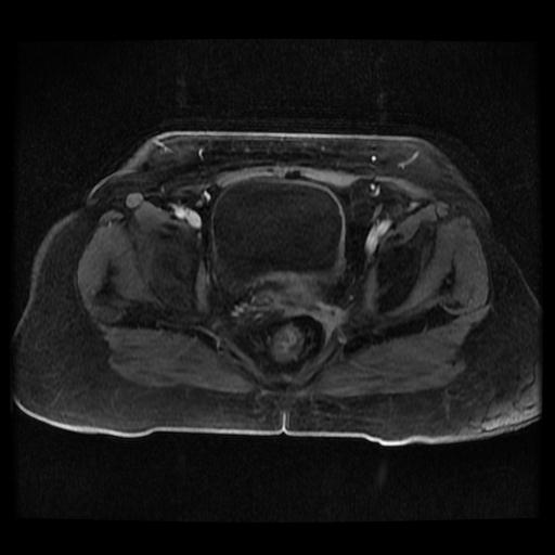 Cervical carcinoma (Radiopaedia 70924-81132 Axial T1 C+ fat sat 48).jpg