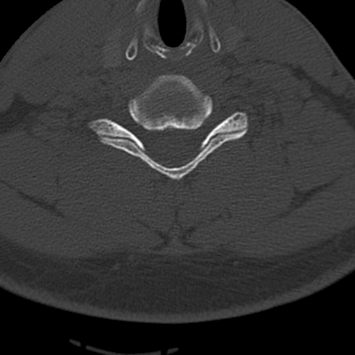 File:Cervical schwannoma (Radiopaedia 57979-64974 Axial bone window 34).png