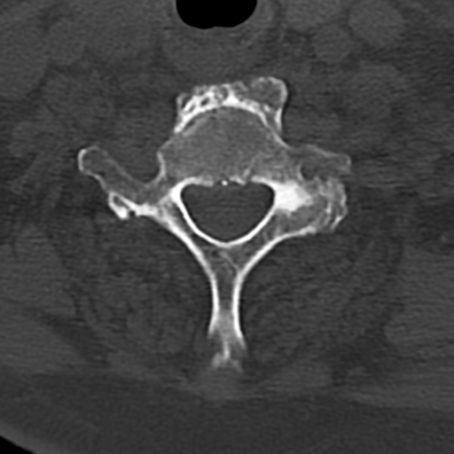 File:Cervical spine fracture - chalk stick (Radiopaedia 39116-41323 Axial bone window 71).png