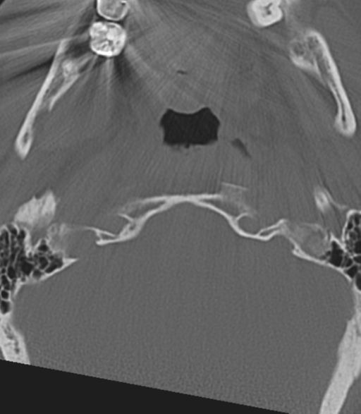 File:Cervical spine fractures with vertebral artery dissection (Radiopaedia 53296-59268 Axial bone window 7).png